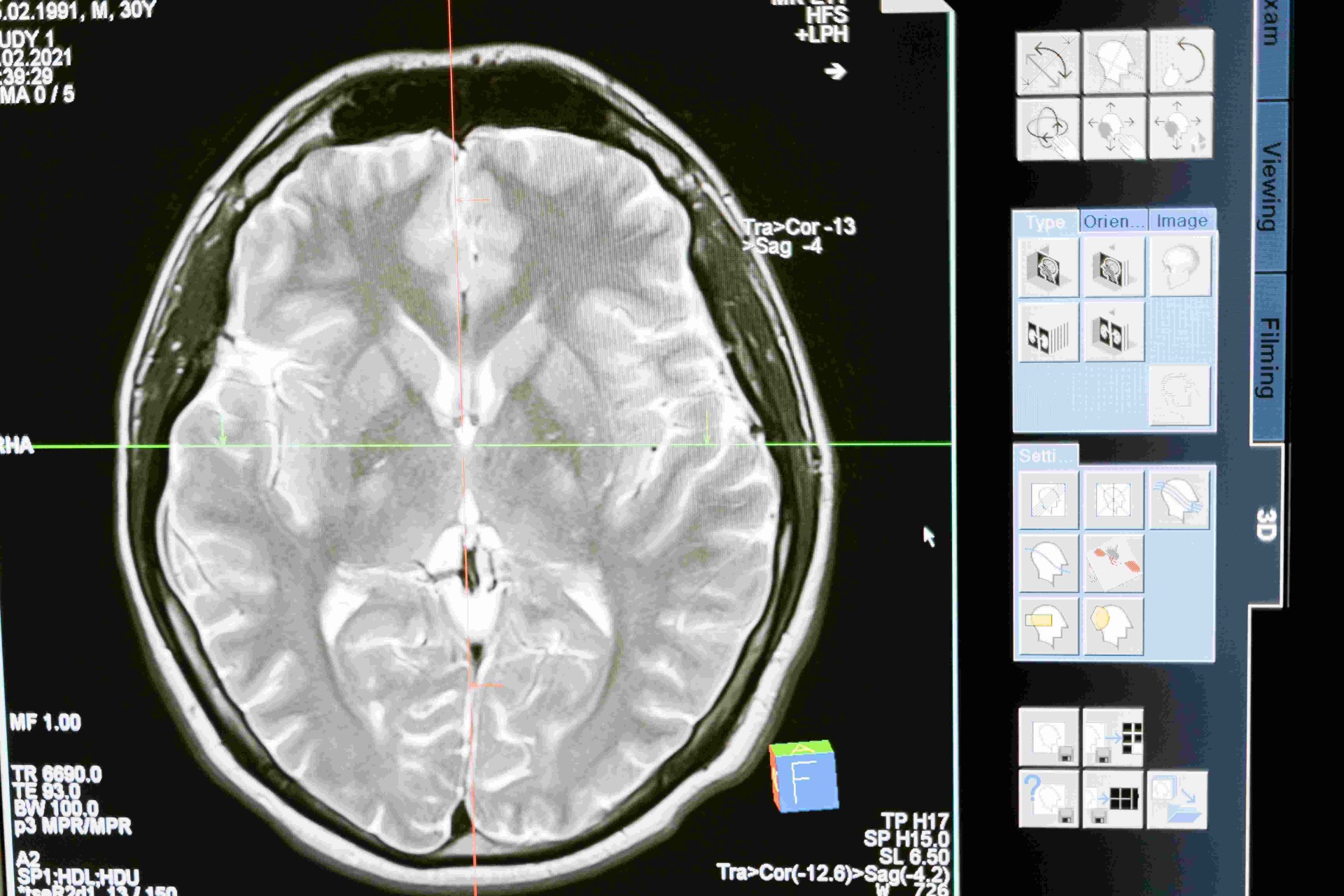 Axial brain MRI scan with crosshair overlay, alongside radiology software interface panels and measurement labels.