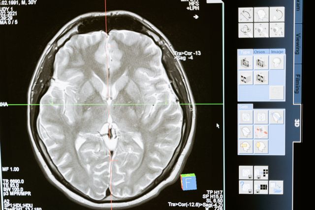 Axial brain MRI scan with crosshair overlay, alongside radiology software interface panels and measurement labels.