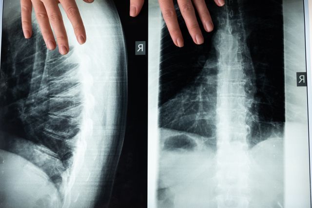 Hands point at spine X-ray images showing lungs, spine, and ribs, with “R” markers.
